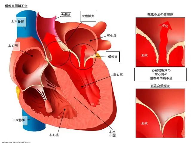 僧帽弁閉鎖不全 | 医療法人 植谷医院